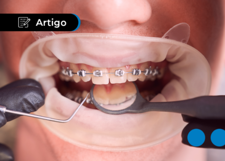 Quanto custa para colocar aparelho: saiba os valores